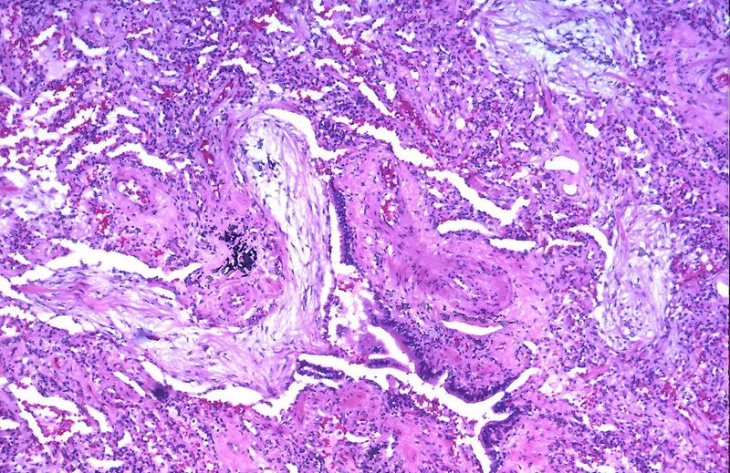 Bronhioliit obliterans mikroskoobis: kopsukude on tihe ja lilla, hingamistee on armkoega ummistunud